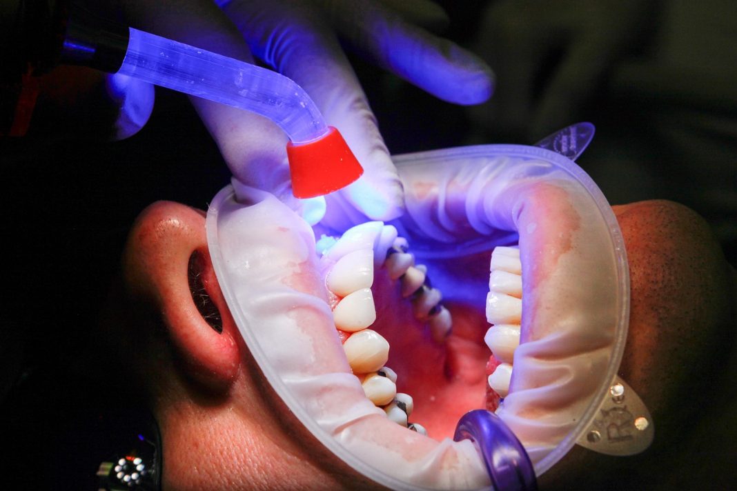 cat dureaza operatia de implant dentar